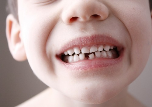 Lietuvos vaikų dantys - vieni prasčiausi Europoje