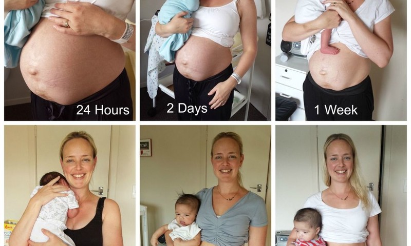 Realios nuotraukos, kaip atrodo moters pilvas po gimdymo