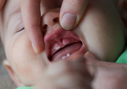9 mėnesių kūdikiui dygsta dantukai su dėmelėmis