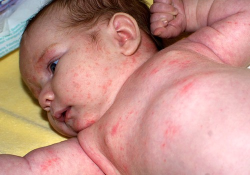 Kaip vaikams nustatoma alergija?