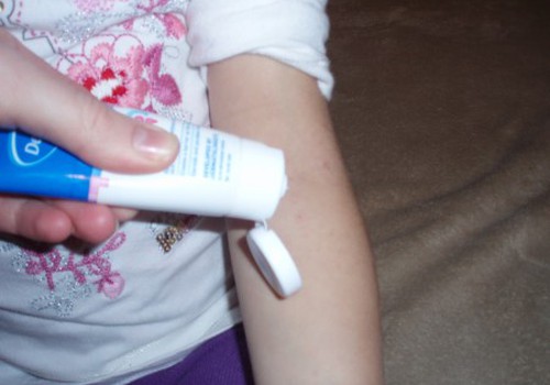 Paūmėjo dukros atopinis dermatitas - pabandėme Dermalex Repair