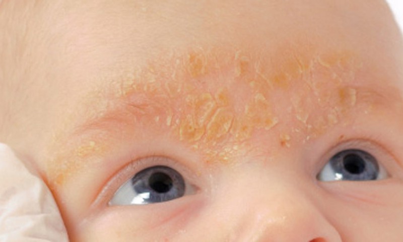 Kaip atskirti paprastas pleiskanas nuo seborėjinio dermatito?