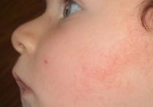 Tikroji ir pseudo-alergija: kaip jas atskirti