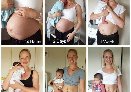 Realios nuotraukos, kaip atrodo moters pilvas po gimdymo