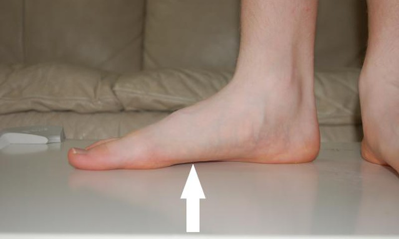 Kada ir kaip išsivysto plokščiapėdystė?