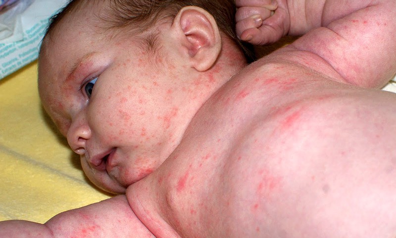 Kaip vaikams nustatoma alergija?
