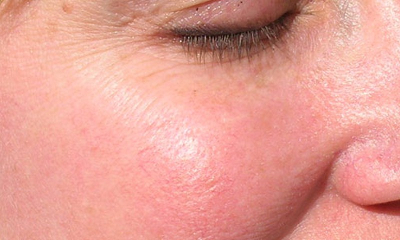 Nuolat raustantys žandai – rimtos ligos pranašas