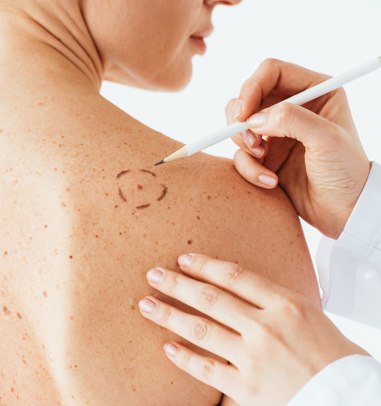 Melanoma serganti vilnietė: neįtariau, kad mažas apgamėlis baigsis tokia klastinga liga