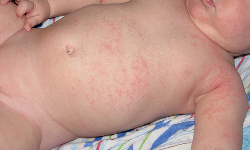 Prakaitinė ar alerginis bėrimas?