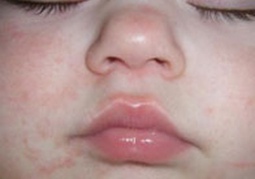 Spuogeliai ant kūno: ar jau alergijos požymis?