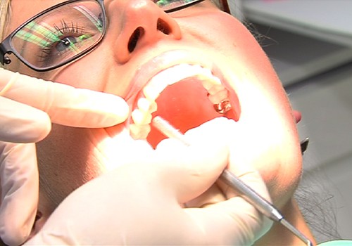 Gražią šypseną gali padėti sukurti dantų implantai
