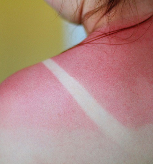 Nudegėte saulėje? 11 natūralių priemonių, kurios palengvins skausmus