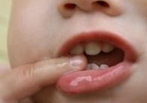 Ar antibiotikai galėjo pagelsvinti pieninius dantukus?