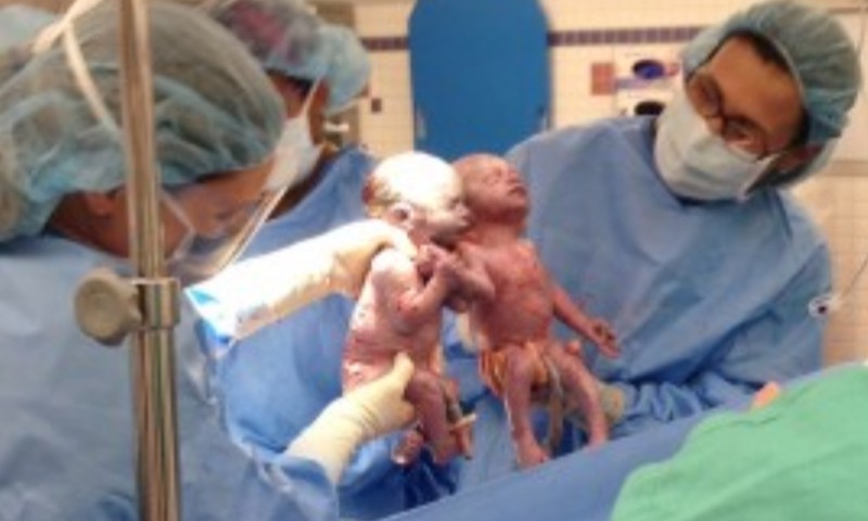 Dvynukės gimė susikibusios už rankų